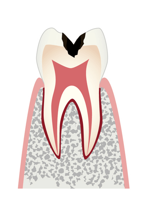中度の虫歯